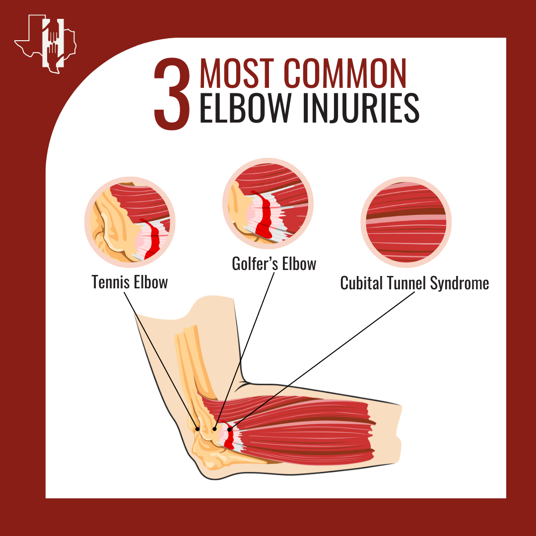 Golfer's Elbow in San Antonio, TX | The Hand & Upper Extremity Center of San Antonio