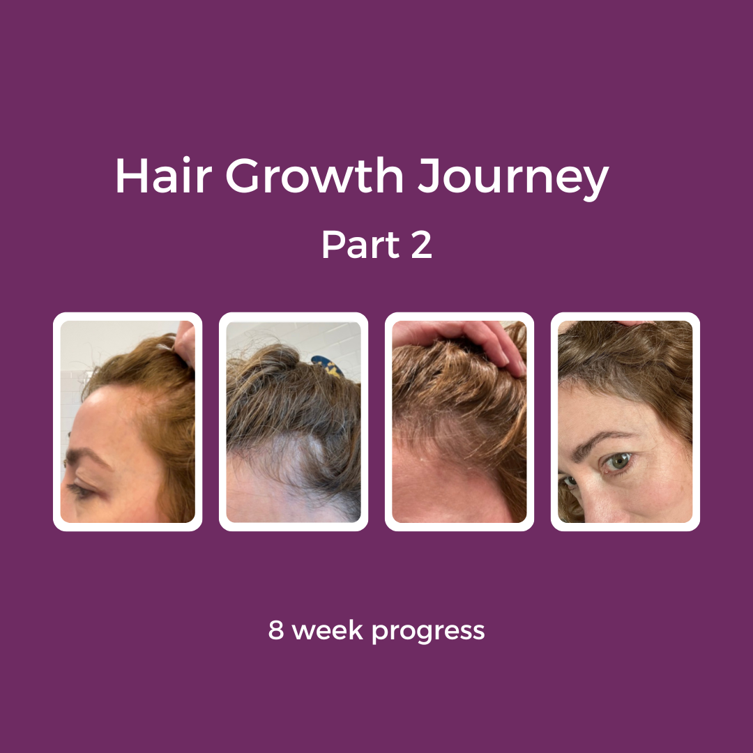 Hair Loss Journey-Part 2 - #49