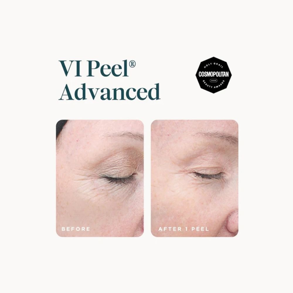 vi-peel-advanced.jpg