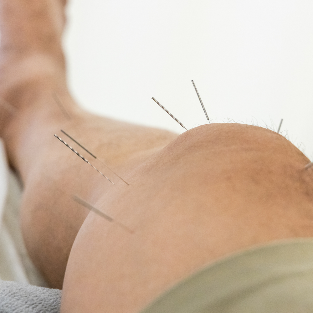 Person receiving medical acupuncture for a sports injury at FM Physio Liverpool