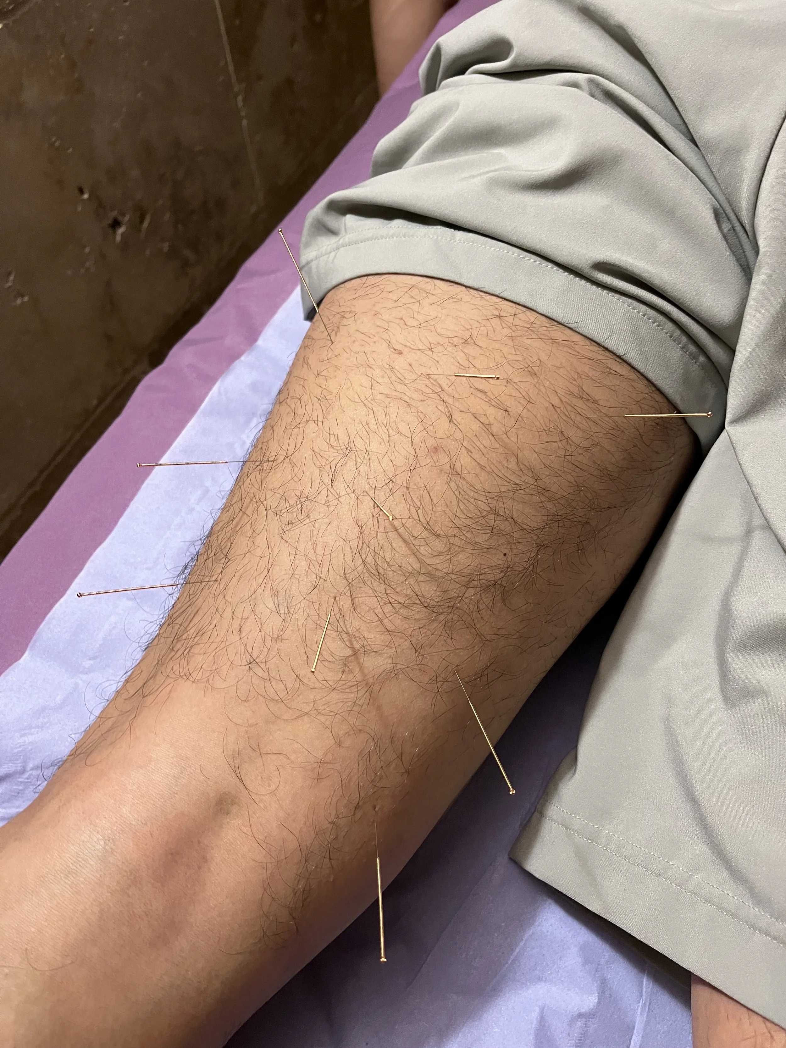 Back Pain Specialist Near Me FM Physio