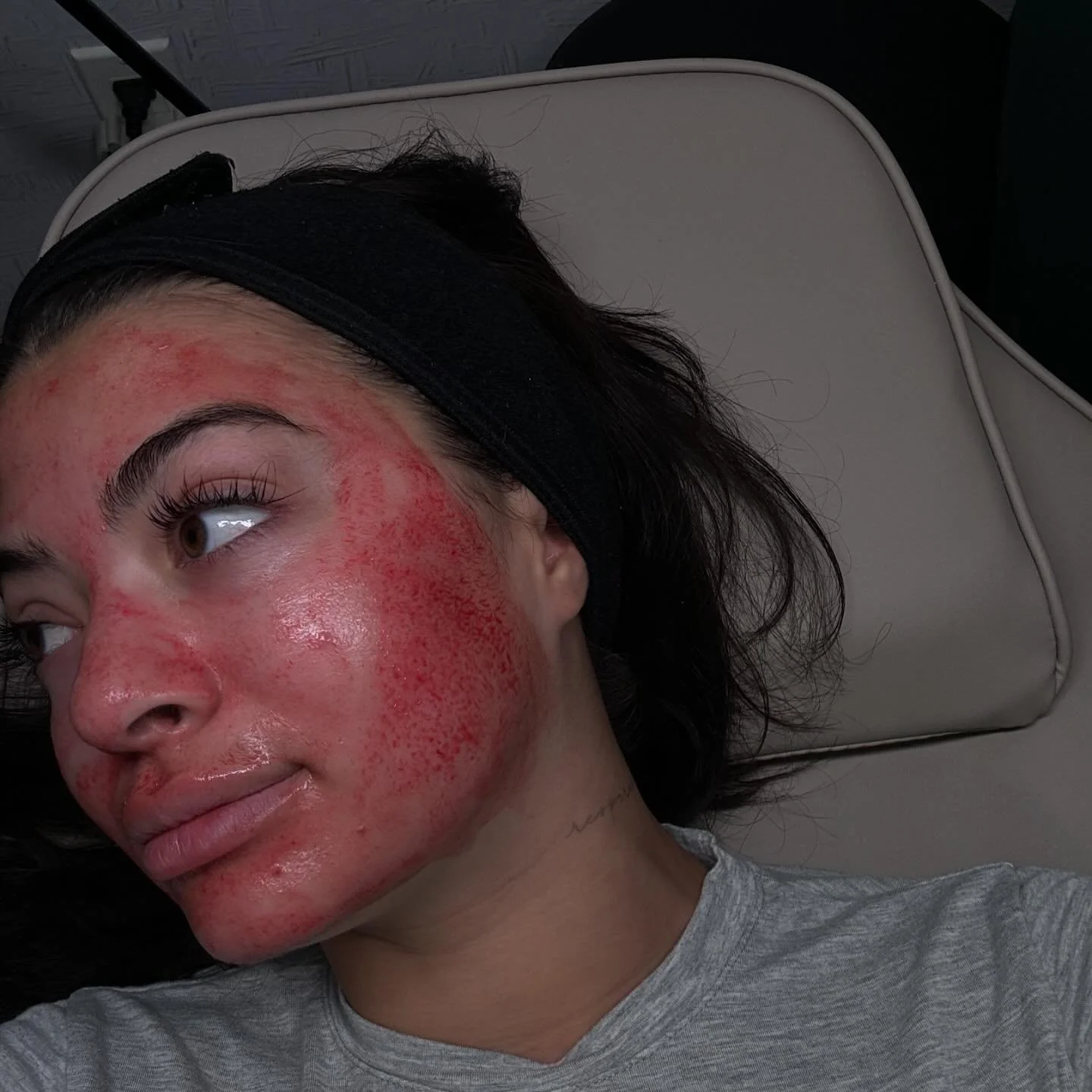 Want glowing fresh skin for Halloween? Shed the dead wrinkly skin with Micro-needling, also known as the vampire facial 🧛‍♀️🩸💉 
This may look scary, but believe it or not this is a very minimally invasive procedure, with very little down time