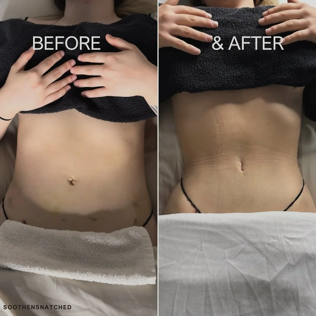 These photos, taken exactly seven days apart, showcase remarkable progress. The image on the left was taken on November 26th, the one on the right is from this morning, December 6th.
This transformation highlights the effectiveness of a Colombian fa