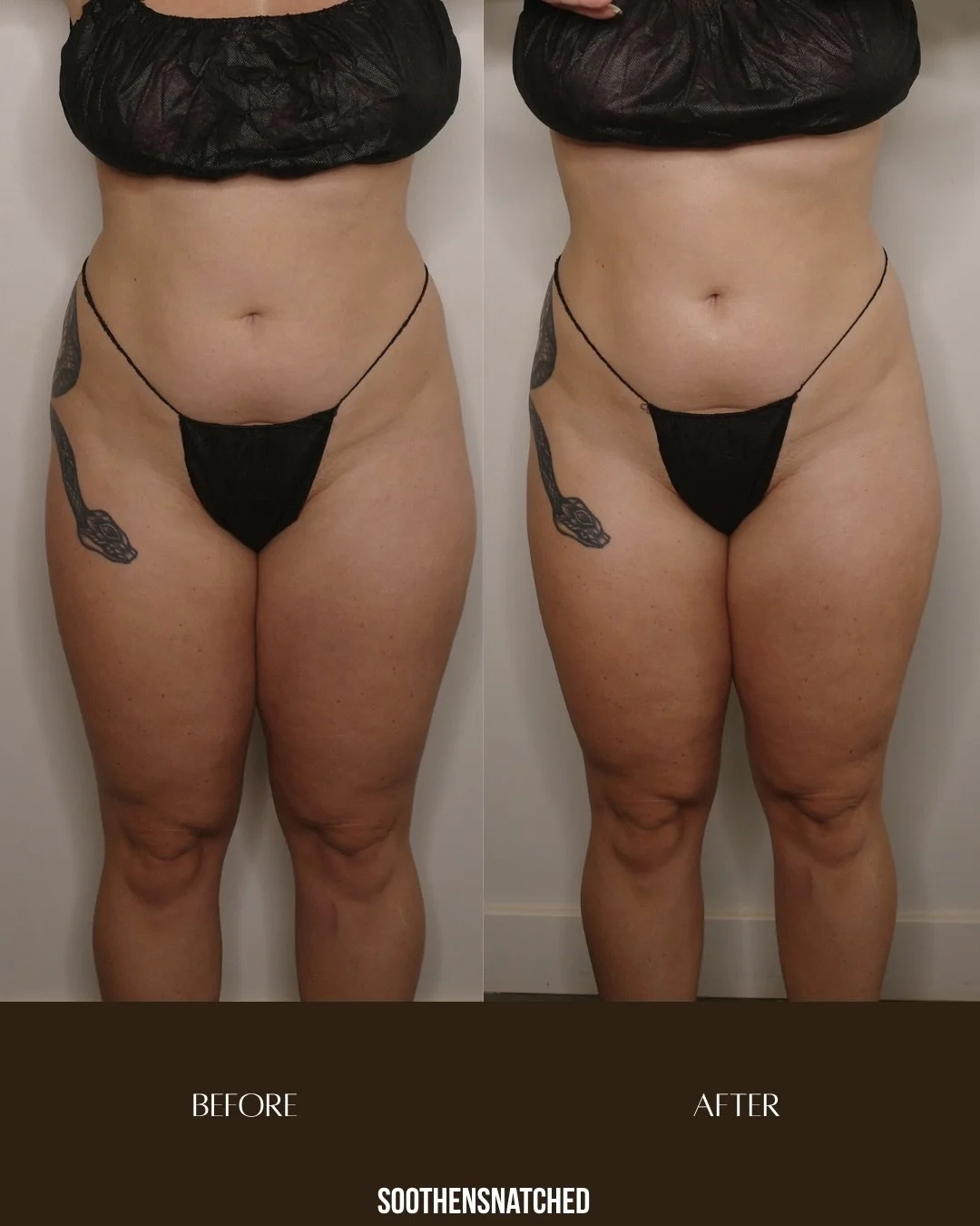 We&rsquo;ve been working 💁🏽&zwj;♀️✨

Before | After &mdash; SNS Full Body Lymphatic Body Contour ⏳

Your all-in-one session designed to detox, de-bloat, sculpt + tighten from head to toe.

Our SNS method combines lymphatic drainage with targeted bo