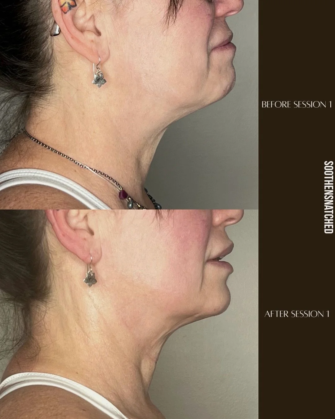✨ AUGUST SPECIAL: UNDER CHIN REDUCTION + JAWLINE ENHANCEMENT ✨

Swipe to see the results. 🤍

These before &amp; afters show what&rsquo;s possible after just 1 session and after 3 sessions of our Under Chin Reduction + Jawline Enhancement treatment.
