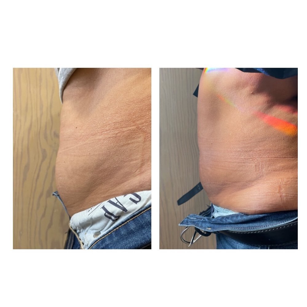 Did you know that BeautyOne offers lipolysis injections? This patient has two treatments completed to her abdomen. 
.
Deoxycholic acid is a naturally occurring bile acid that is found in the human body. It is an FDA-approved injectable treatment for 
