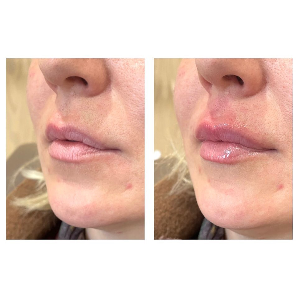 Beautiful, natural, hydrated lips. Pre and immediately post treatment. Redness and swelling is normal and subsides by the two week mark. 
.
Book a complimentary consultation today to discuss lip filler!
.

#torontolipinjections #torontolipfiller #tor