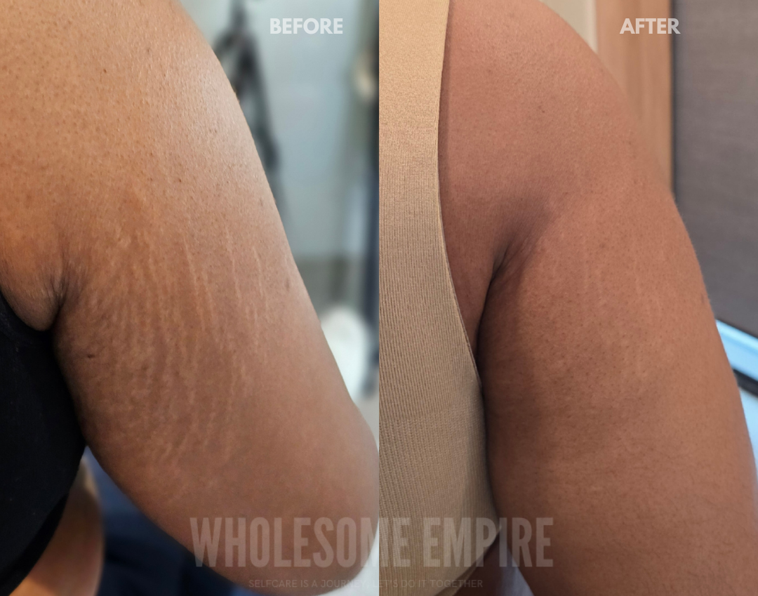 Upper-arm stretch-mark comparison published by Wholesome Empire