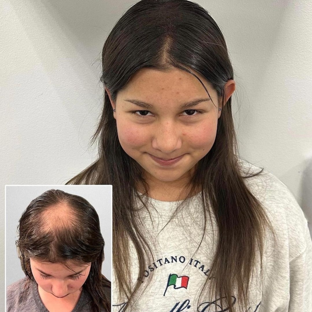 Hair-density comparison showing the part and crown