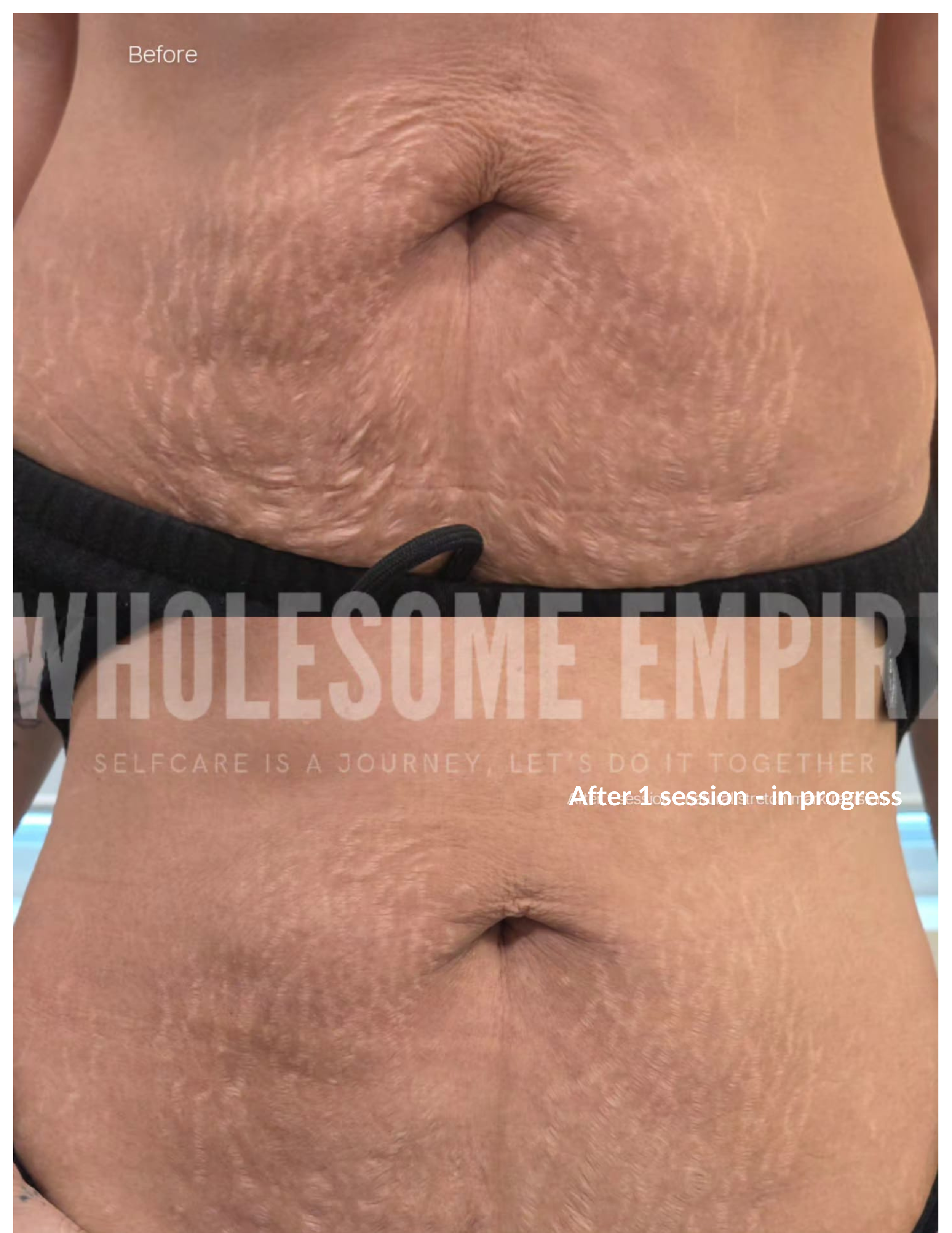 tummyWholesome Emp. Cases.png
