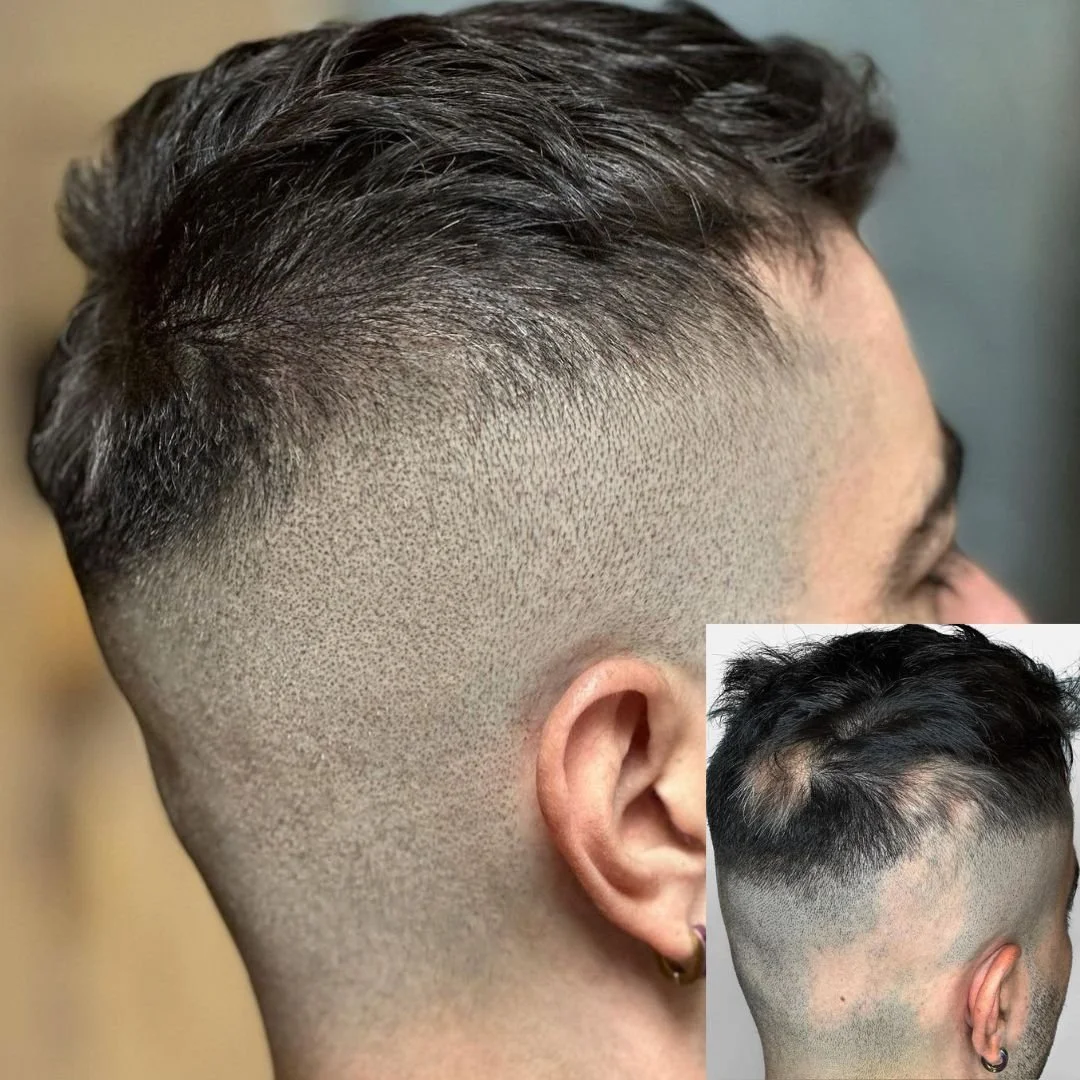 SMP side-profile comparison showing scalp coverage