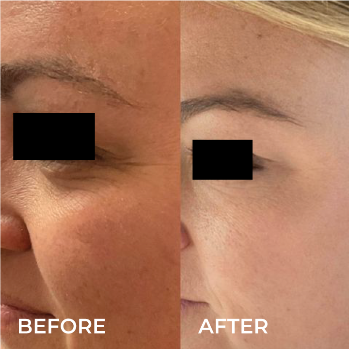 botox before and after eyes.png