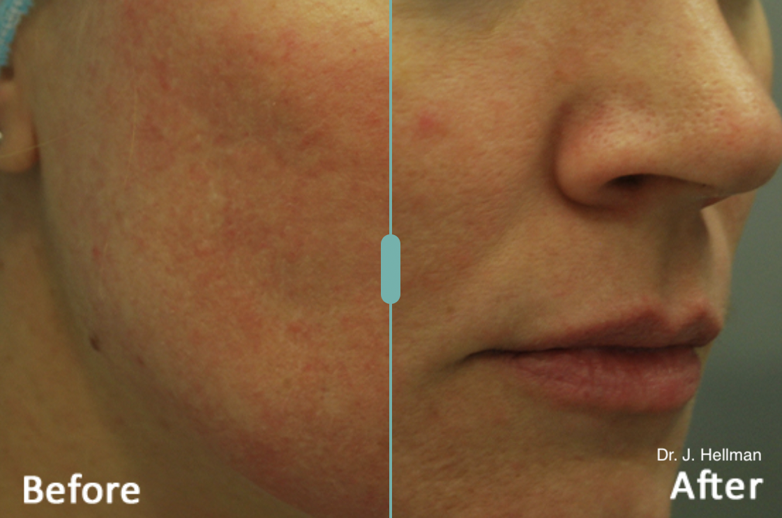 Morpheus 8 before after.png