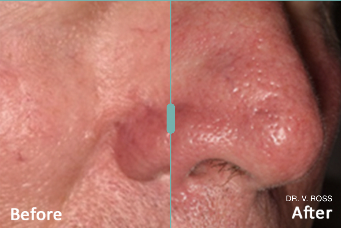 before and after lumecca ipl.png