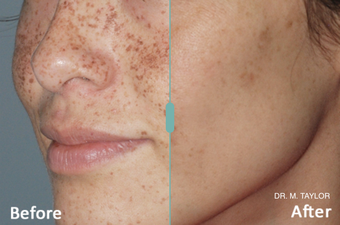 before after lumecca ipl.png