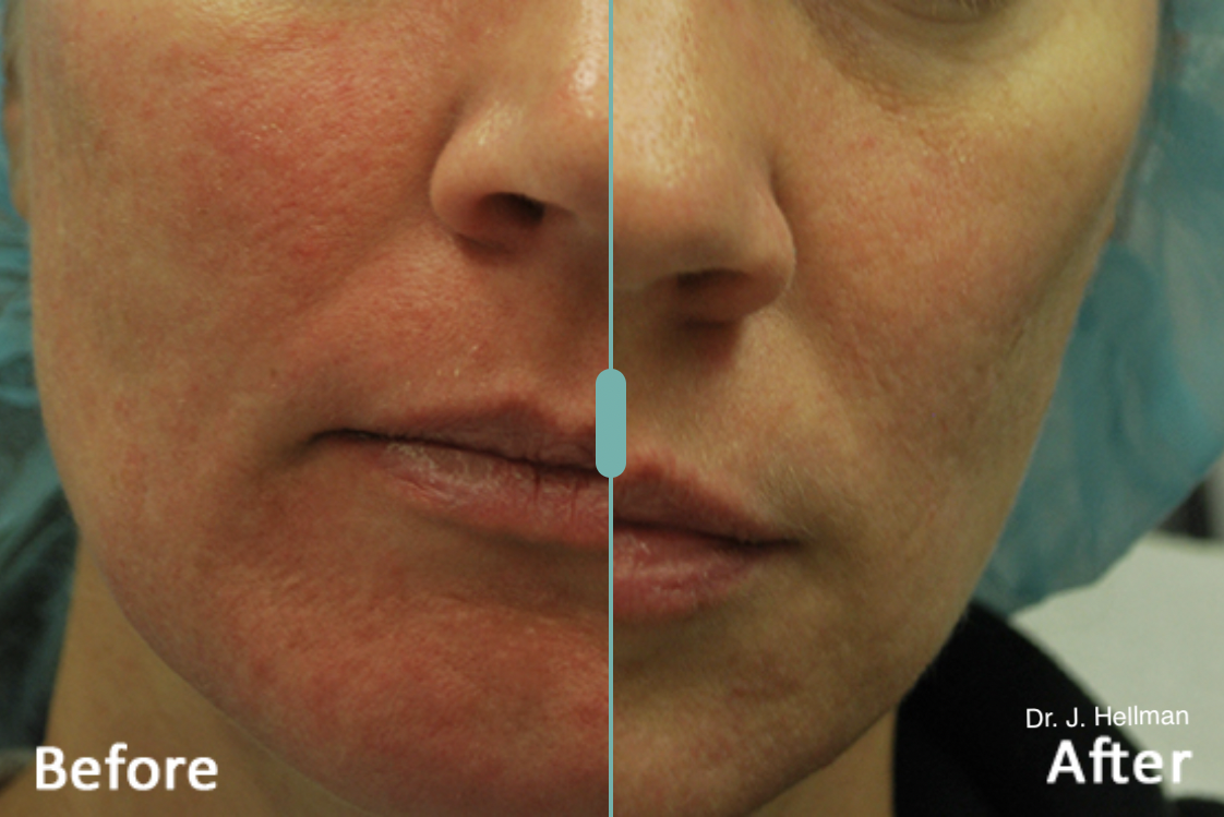 morpheus 8 before and after .png