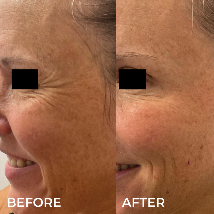 botox before and after crows feet.png