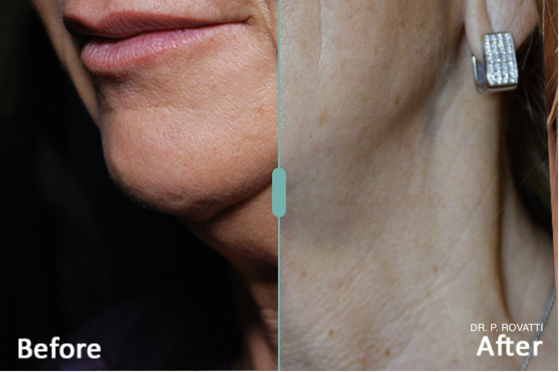 morpheus8 results in myrtle beach.png