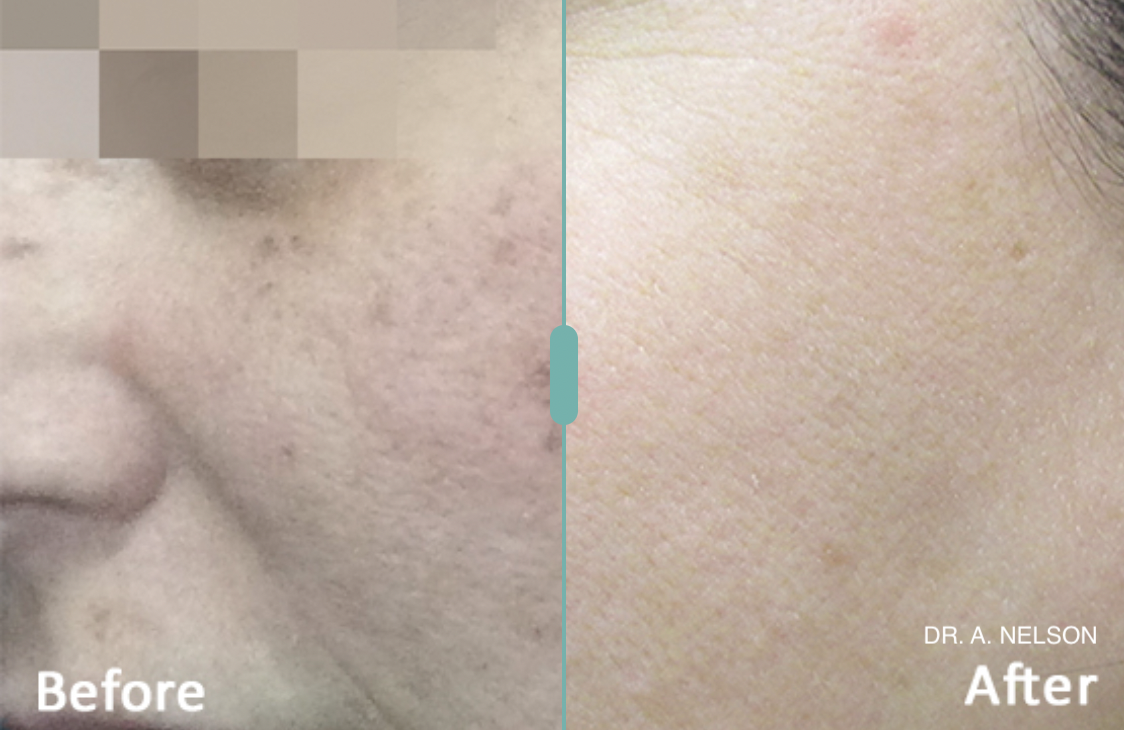 before after lumecca.png