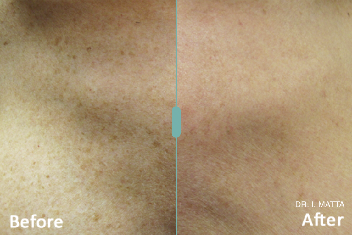 photofacial before after.png