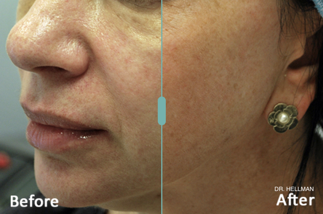 Morpheus8 before and after.png