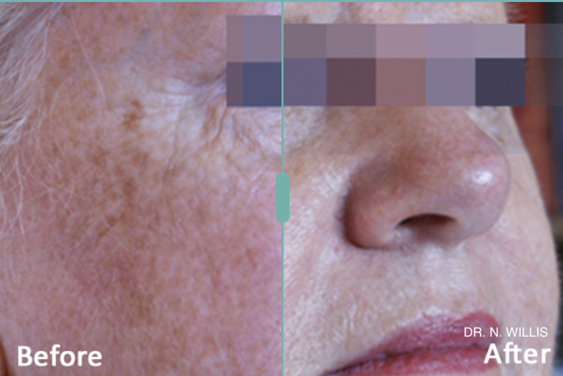 ipl before and after.png