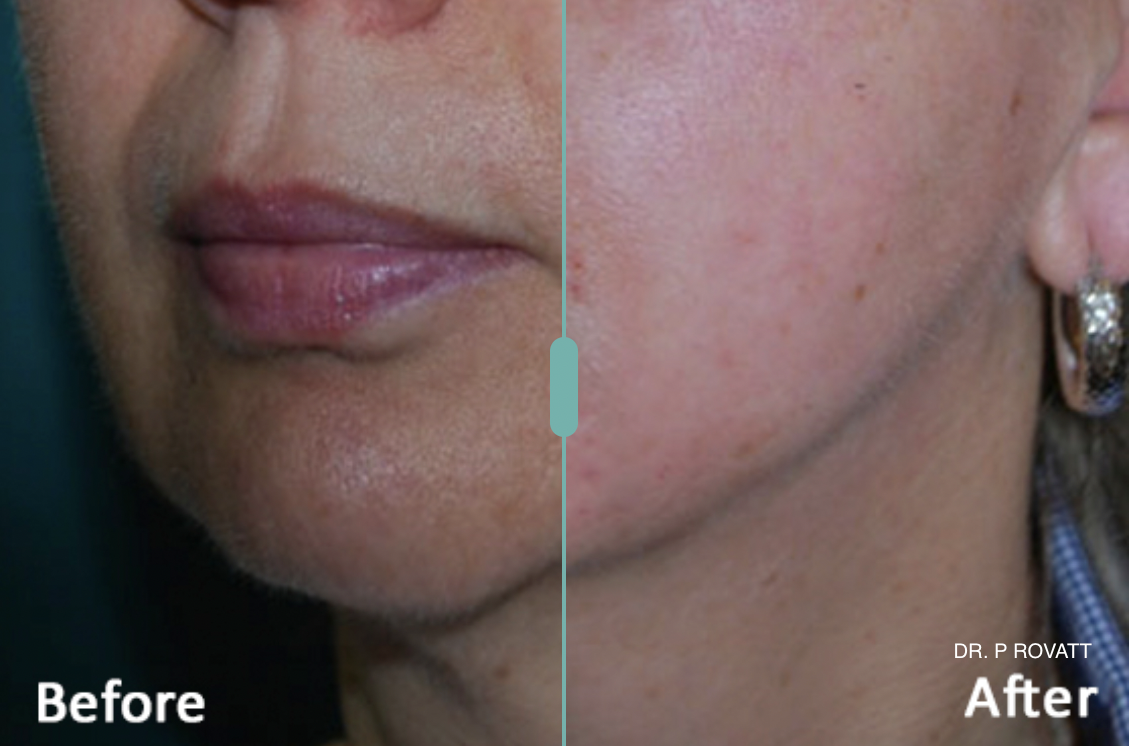 before and after morpheus 8.png