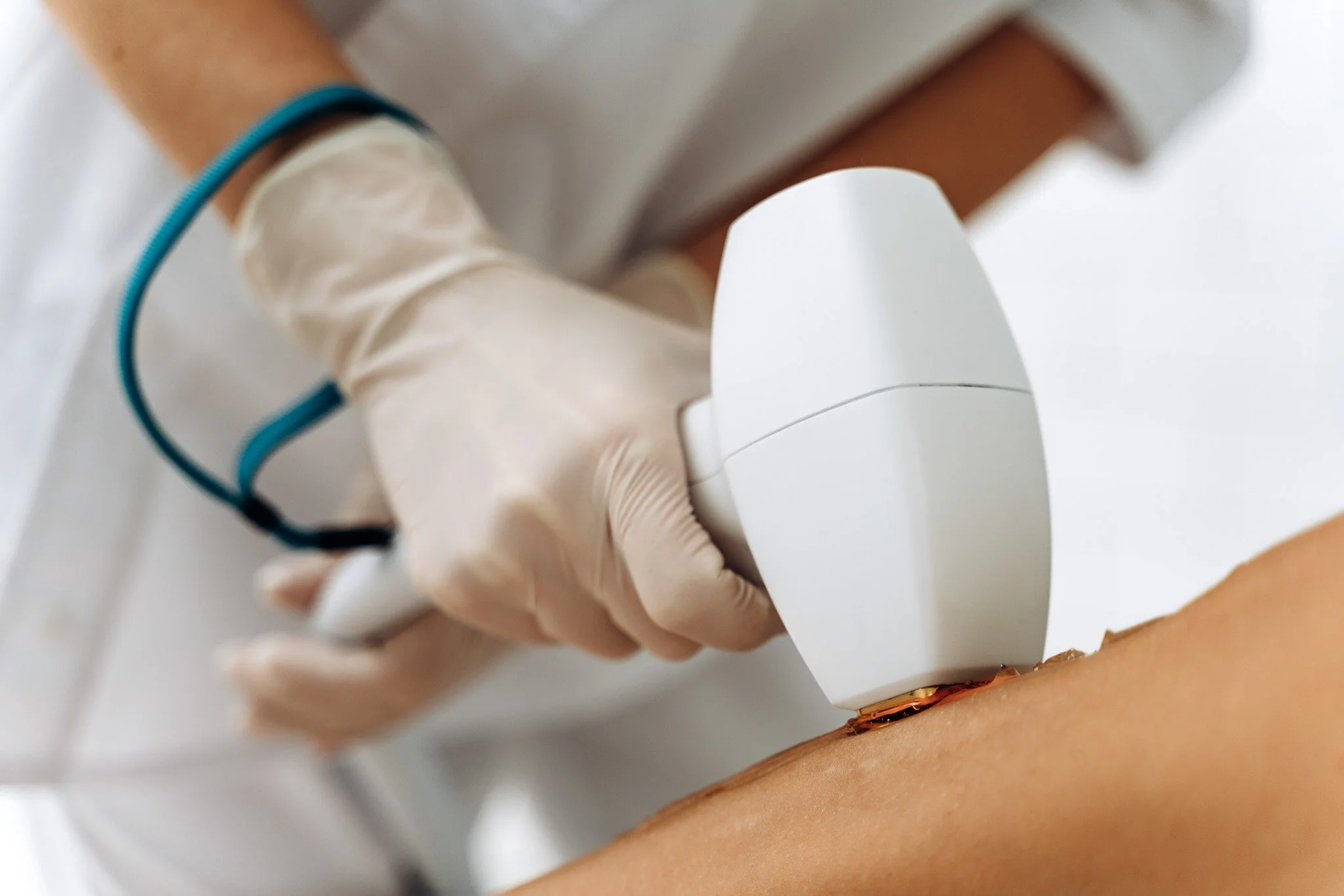 Laser Hair Removal in Myrtle Beach