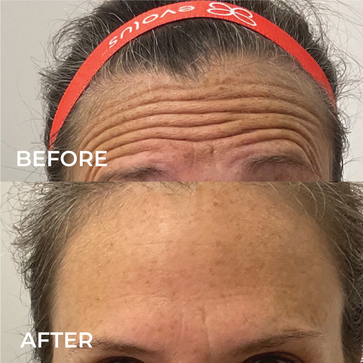 before-and-after-botox-forehead.png
