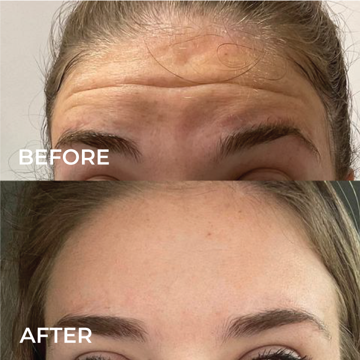 botox for migraines before and after pictures.png