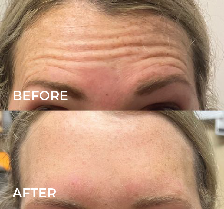 brow lift with botox before and after.png