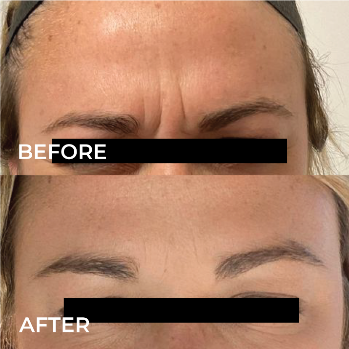 before-and-after-botox-for-frown-line.png