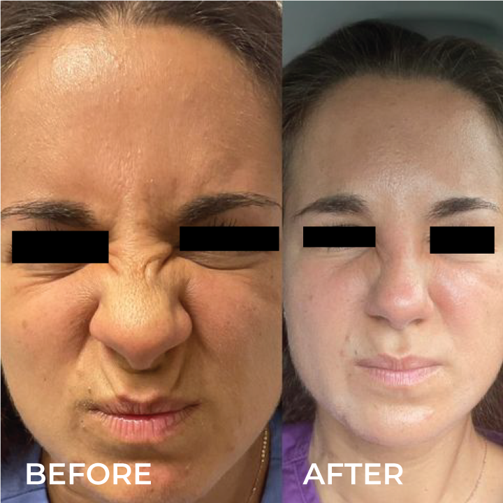 smile lines botox.png