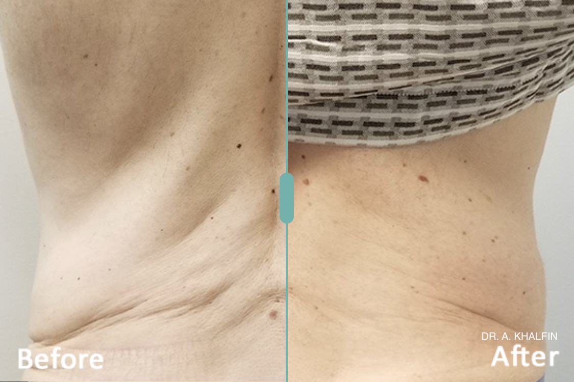 morpheus 8 results before and after.png