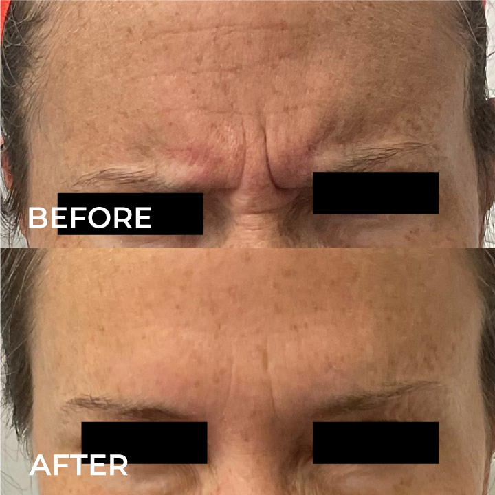 botox for frown lines before and after.png