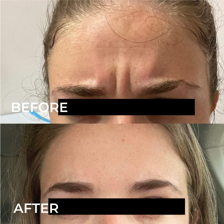 before-and-after-botox.png