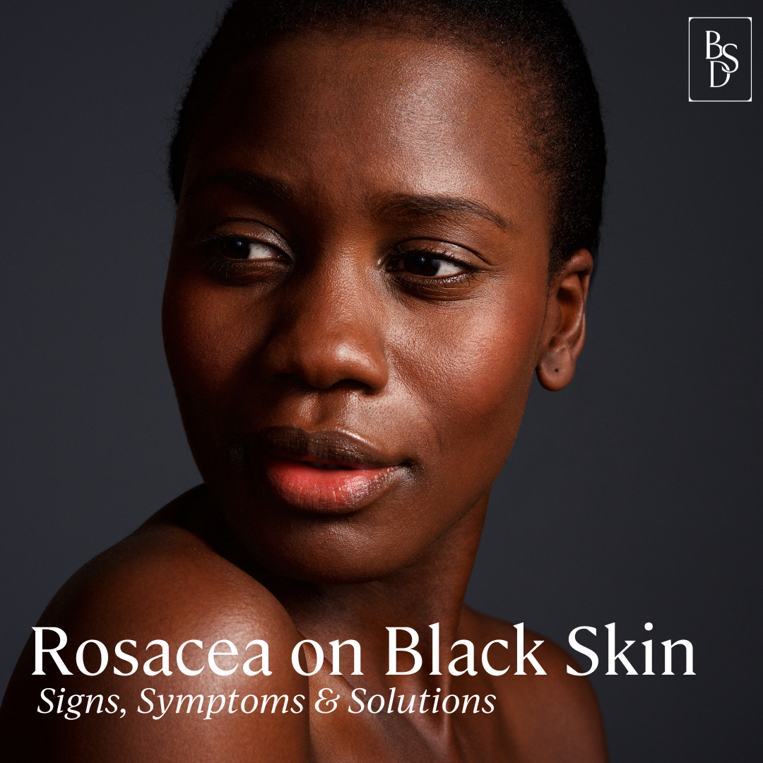 Everything You Need To Know About Black Skin and Rosacea — Black Skin