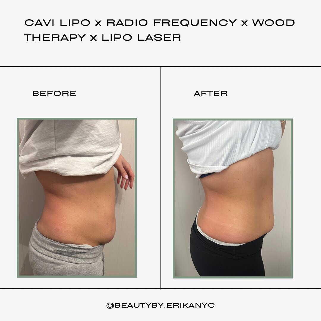 Consistency is key! 🔑 
Radio Frequency x Cavi-Lipo x Lipo Laser

BENEFITS
* Non invasive
* Reduces and breaks down stubborn fat
* No down time
* Tightens and tones
* Reduces cellulite 
* Helps detox the body
* Enhances body shape and appearance 

📲