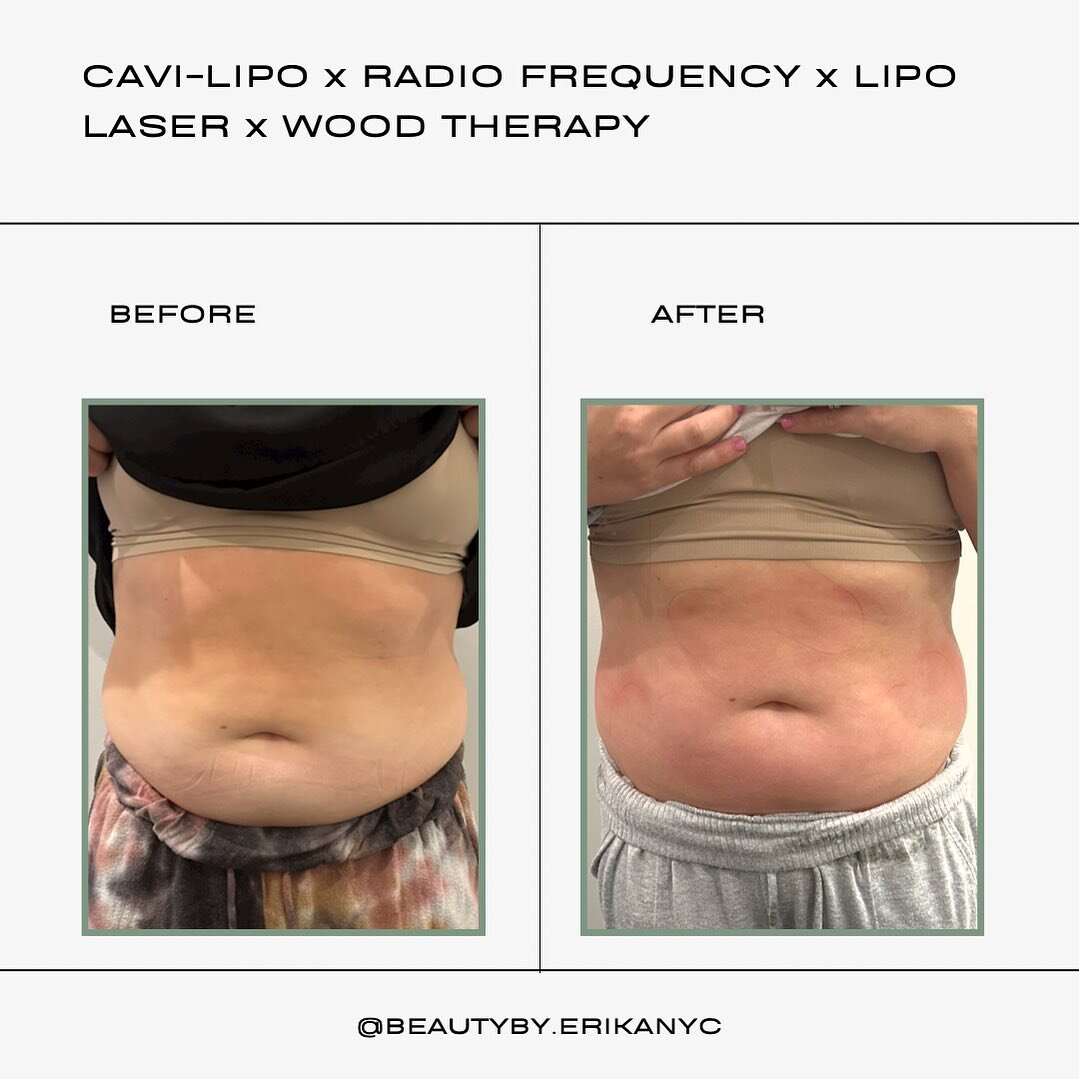 6th session! These results though! 👏
So proud of my clients for being consistent and doing their part by drinking plenty of water and maintaining a healthy lifestyle! ✨

Treatment: Radio Frequency x Cavi-Lipo x Lipo Laser

BENEFITS
*  A Non-invasive