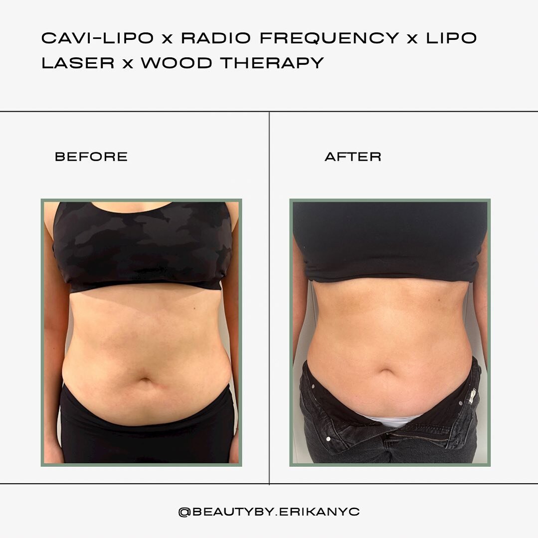 We love progress photos!!
These pics are about a month and a half apart, with 1-2 sessions per week. ✨

Treatment: Radio Frequency x Cavi-Lipo x Wood Therapy x Lipo Laser

BENEFITS
*  A Non-invasive way to reduce fat
*  Tones and Sculpts your body
* 