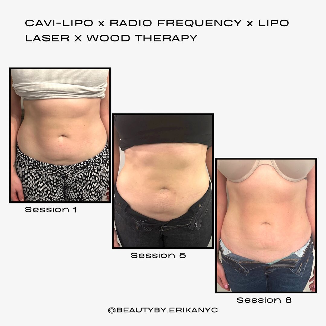 Getting my clients ready for summer! 🌞

In love with these progress photos! 
Consistency is Key! Along with a healthy diet and exercise! 🔑 ✨

Treatment: Radio Frequency x Cavi-Lipo x Wood Therapy x Lipo Laser

BENEFITS
*  Breaks down fat cells
*  T