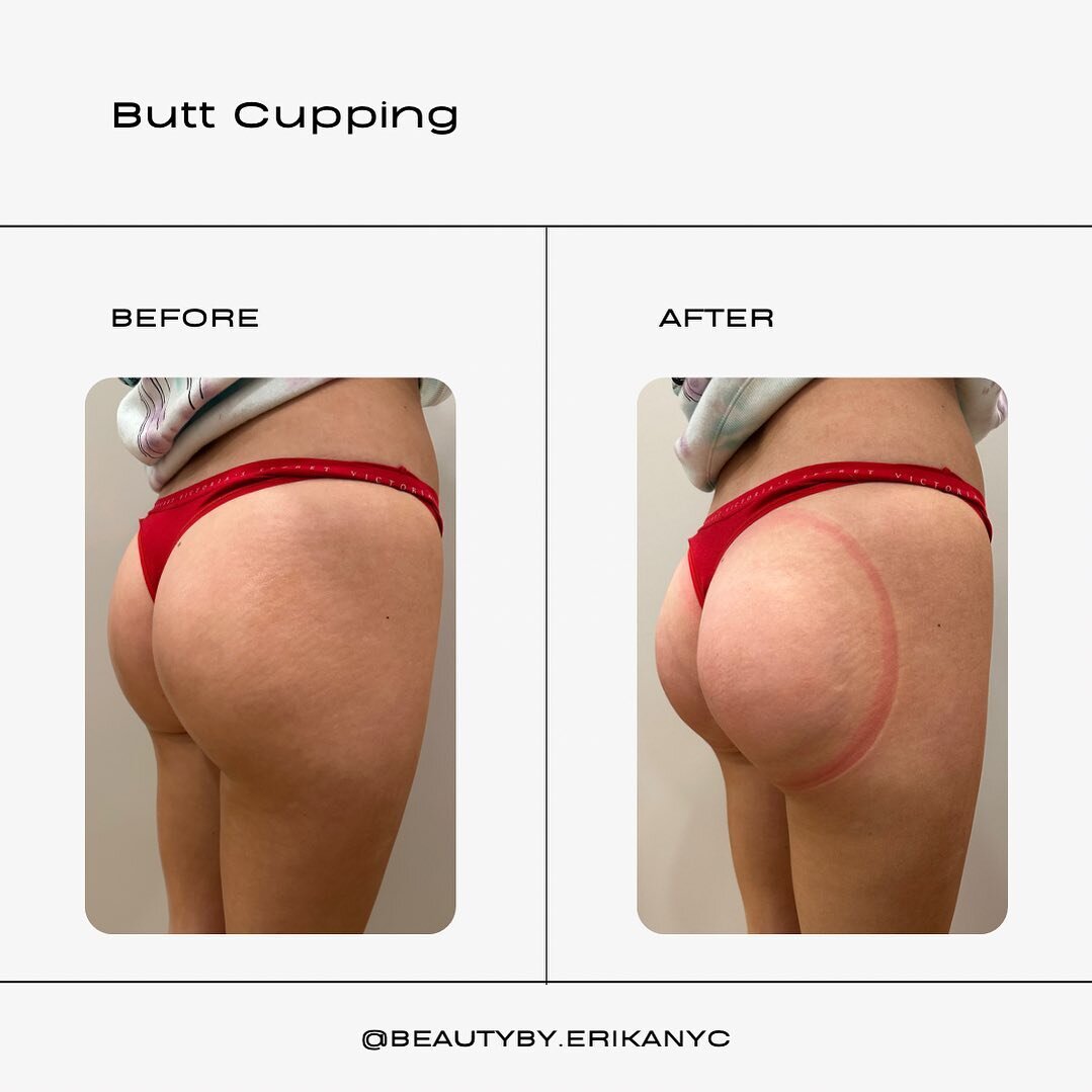 Plump, lifted &amp; ready for summer!!🍑🌞
Immediate results! 
1500-2000 squats per session!

BENEFITS
* Lifts your buttocks by up to 70%
* instant results
* No surgery, no pain, no downtime!
* Enhanced body tone and shape
* Reduces appearance of cel