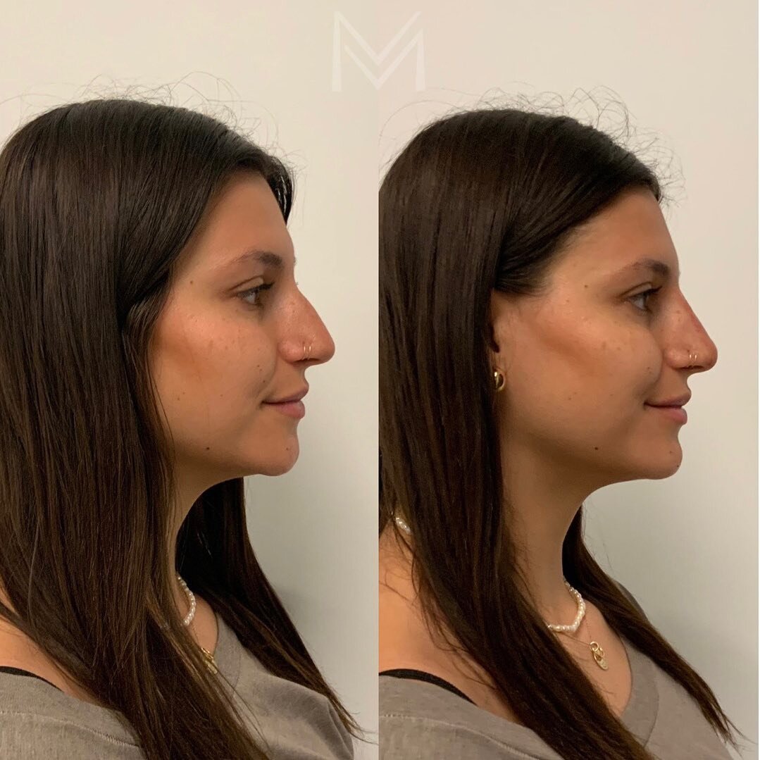 ✨ Instant Gratification ✨

We all know I love full facial rejuvenation surgery, but sometimes, all you need is 20 minutes for a beautiful transformation! 

This patient was bothered by her nasal dorsal hump, but was not ready for a surgical rhinoplas