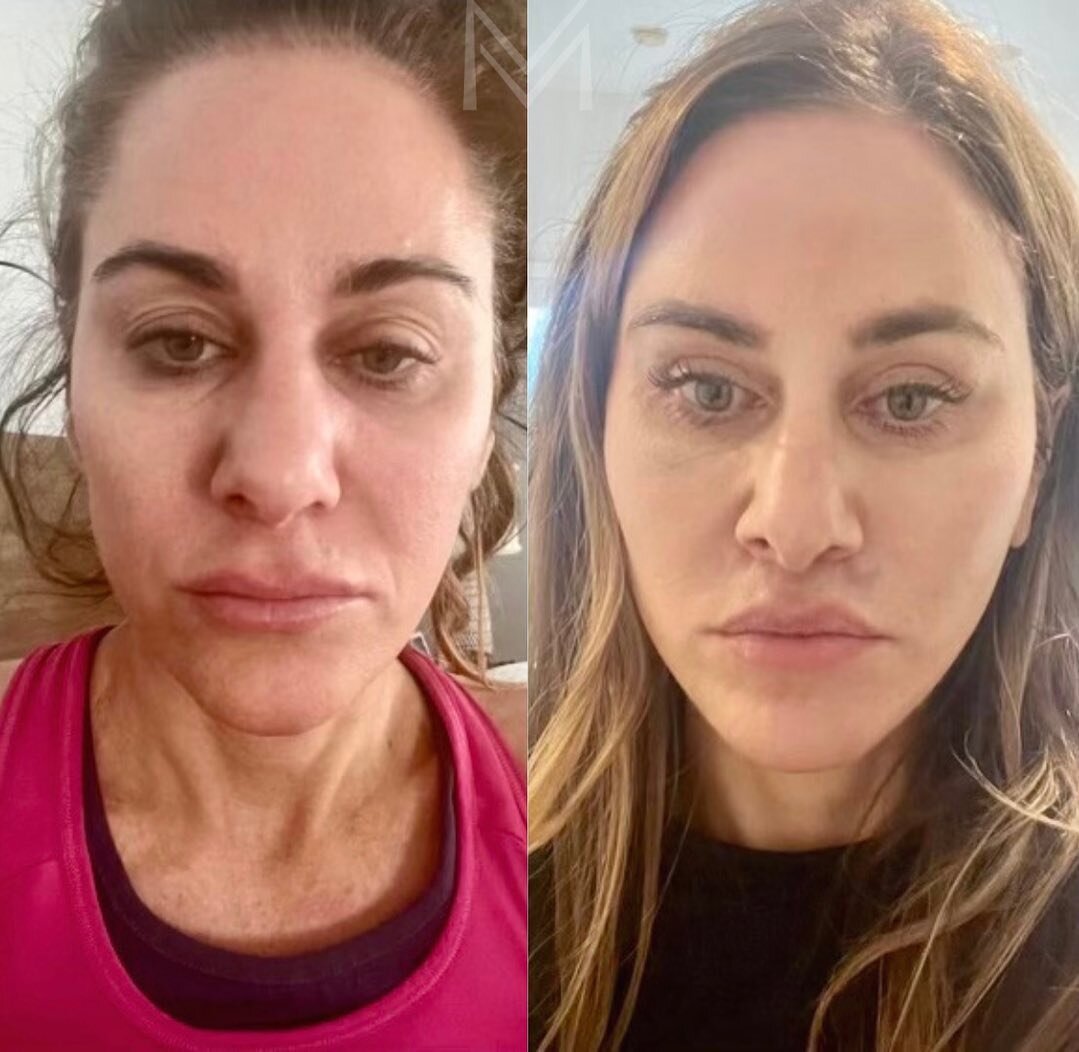 Only 2 weeks after surgery and looking 🔥🔥🔥

My stunning (and hilarious!) patient sent these selfies in this week and I was blown away. Talk about restoring the heart shape face of youth!

She is only 2 weeks after deep plane facelift, neck lift, l