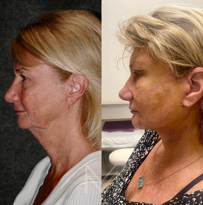 What does a deep plane facelift look after 1 week? ✨THIS✨ 

My sweet patient is exactly 7 days out from her deep plane facelift, neck lift, upper blepharoplasty, and temporal brow lift. She is still swollen and a bit bruised, but overall, healing bea