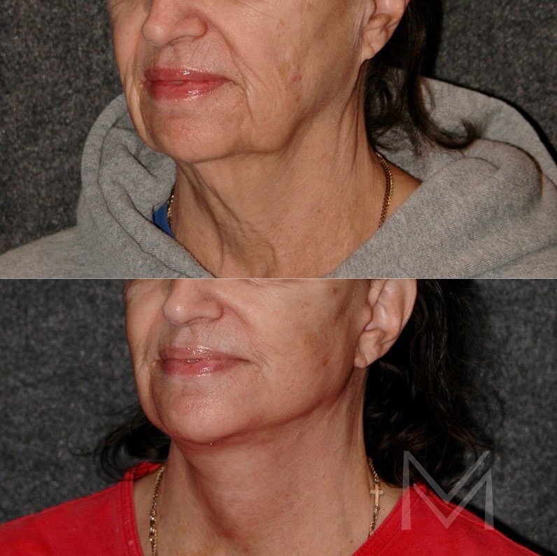✨Facelift Friday✨

My lovely 68 year old patient asked me not to share her eyes, but there&rsquo;s no hiding her transformation!

Like many of my patients, she didn&rsquo;t feel her aged appearance matched the way she felt. I performed a deep plane f
