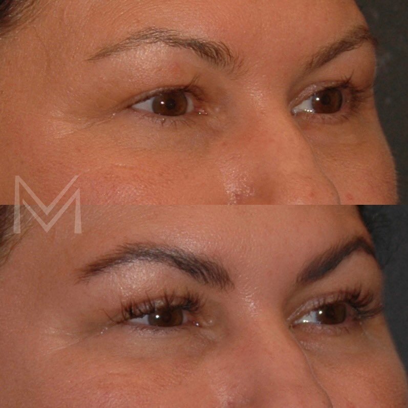It&rsquo;s amazing how one small procedure can really brighten up the eyes and entire face! 

My lovely patient was bothered by her heavy upper eyelids so I performed an in-office upper blepharoplasty with local anesthesia. She is just 2 weeks out he