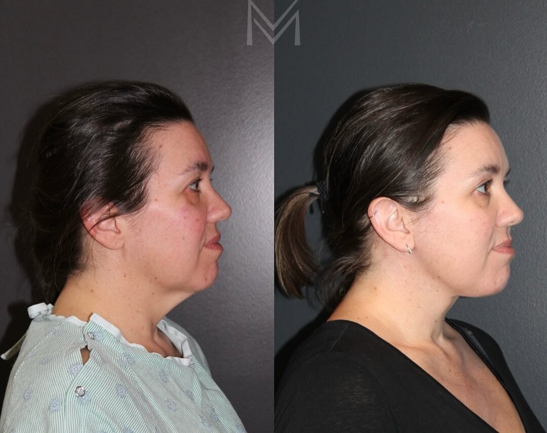 This lovely 45 year old patient of mine lost a considerable amount of weight and as a result, developed loose neck skin. No amount of liposuction or energy devices would give her the result she desired- a surgical intervention was required. 

I perfo