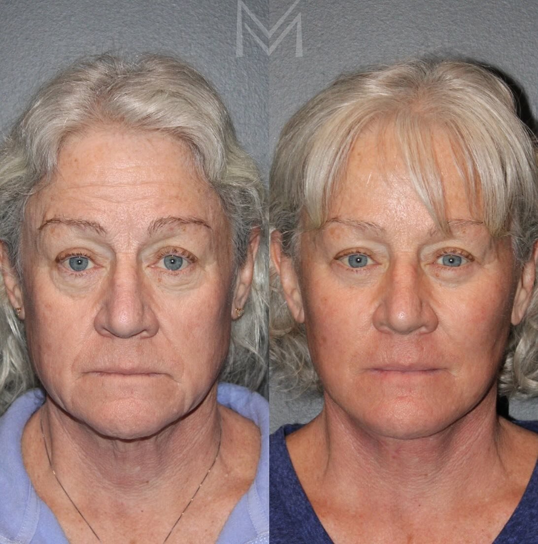 Softer, brighter, more youthful&hellip;but still YOU. 

I am obsessed with these photos from my lovely patient who is just 3 months out from a deep plane facelift, neck lift, facial fat grafting, and lower blepharoplasty with fat repositioning, skin 