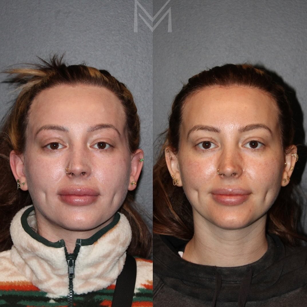 🌟Hairline lowering/Forehead reduction🌟 

I call this the &ldquo;something&rsquo;s different, but what? 🤔&rdquo;procedure. It yields subtle facial balancing that can make a big difference! 

This beautiful patient is just 6 weeks after her hairline